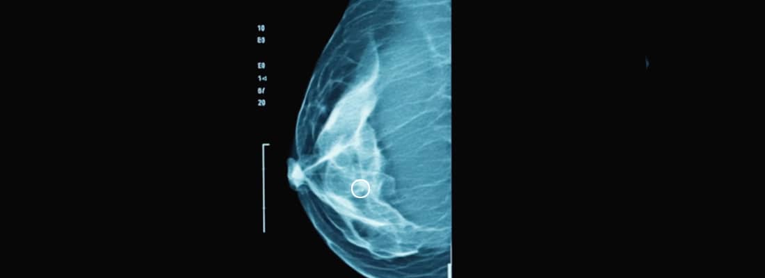 tomosynthesis